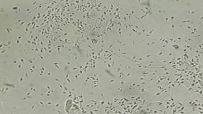Leukozytospermie - Mikroskopische Untersuchung. Urologenzentrum Wien - Leukozytospermie: Mikroskopaufnahme von Spermien mit Leukozyten im Ejakulat.