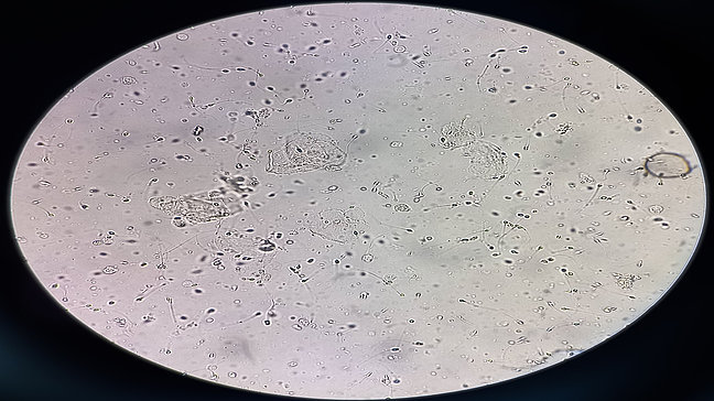 Urologenzentrum Wien - Leukozytospermie unter dem Mikroskop, weiße Blutkörperchen im Sperma sichtbar.