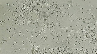 Urologenzentrum Wien - Leukozytospermie: Mikroskopaufnahme von Spermien mit Leukozyten im Ejakulat.