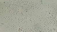 Urologenzentrum Wien - Leukozytospermie: Mikroskopaufnahme von Spermien mit Leukozyten im Ejakulat.