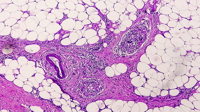 Urologenzentrum Wien - Spermagranulom bei einer Gewebeprobe, mikroskopische Ansicht.