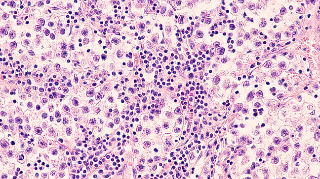 Urologenzentrum Wien - Seminom, histologische Aufnahme von Tumorgewebe.