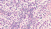 Urologenzentrum Wien - Seminom, histologische Aufnahme von Tumorgewebe.