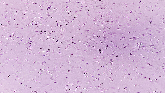 Urologenzentrum Wien - Teratozoospermie unter dem Mikroskop, abnormale Spermienformen sichtbar.