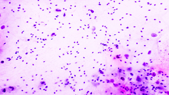Urologenzentrum Wien - Oligozoospermie unter einem Mikroskopbild von Spermien.