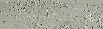 Leukozytospermie - Mikroskopische Untersuchung. Urologenzentrum Wien - Leukozytospermie: Mikroskopaufnahme von Spermien mit Leukozyten im Ejakulat.