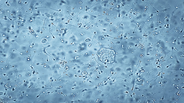 Asthenozoospermie - Mikroskopische Ansicht von Spermien. Urologenzentrum Wien - Asthenozoospermie unter einem Mikroskopbild von Spermien.