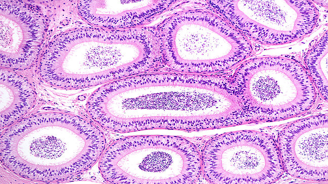Nebenhodenentzündung – Mikroskopische Ansicht der Gewebeprobe. Urologenzentrum Wien - Nebenhodenentzündung bei einer Gewebeprobe, mikroskopische Ansicht.