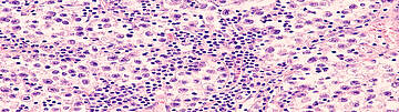 Urologenzentrum Wien - Seminom, histologische Aufnahme von Tumorgewebe.
