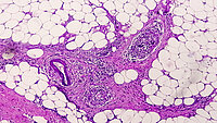 Urologenzentrum Wien - Spermagranulom bei einer Gewebeprobe, mikroskopische Ansicht.